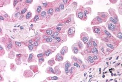 Immunohistochemistry: NEK6 Antibody [NBP3-14415] - Immunohistochemistry of lung, non-small cell carcinoma,